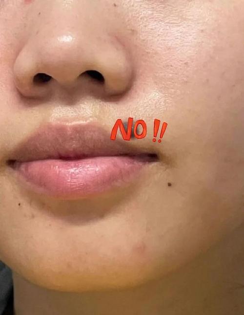 嘴唇朱砂痣去掉好不好