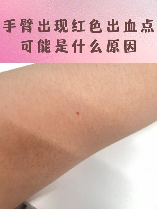 胳膊上朱砂痣能否點掉