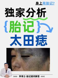 臉上有胎記好嗎？體相中面部胎記詳細分析