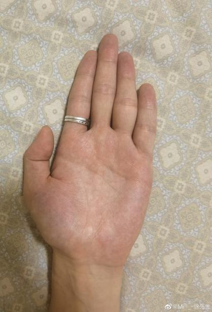 女人小拇指內彎的人命不好