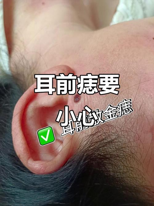 耳朵前面有痣