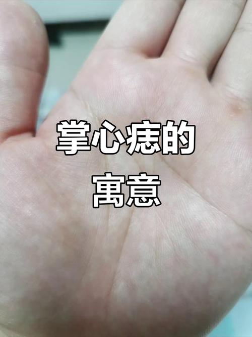 右手手掌有痣