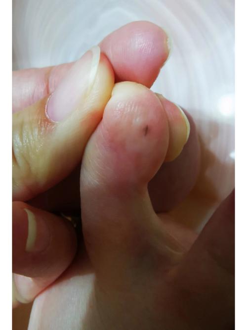 腳趾頭上有痣