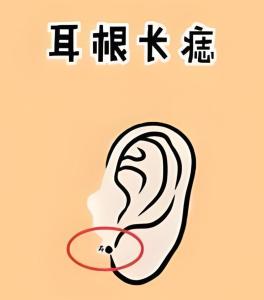 耳根痣在哪