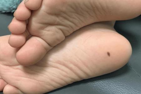 腳踝長痣 頸部長痣是不是不好
