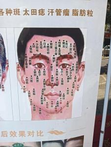 解析你面部的好痣和壞痣