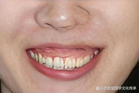 面相分析笑起來牙齦外露的人