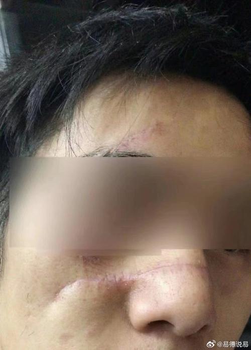 鼻梁有疤男人面相 自身的氣場弱