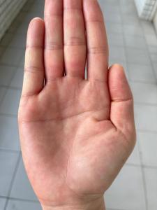 斷掌紋的男人，男人左手斷掌