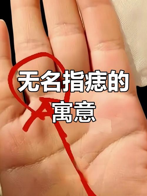 女人右手無名指長新痣 事業(yè)運勢較喜人