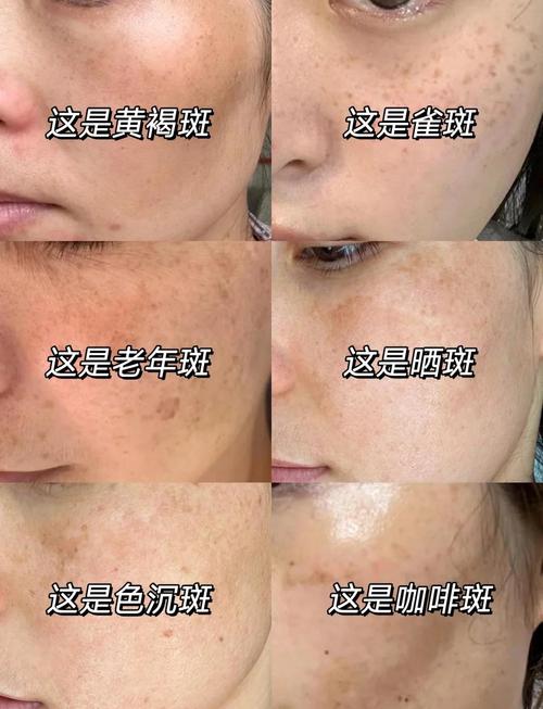 臉上長(zhǎng)斑好嗎