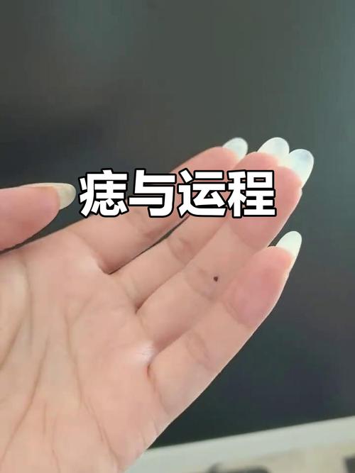 左手無名指長痣的女人 財運婚姻皆不錯