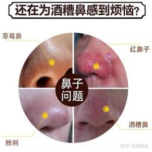 面生酒糟鼻有財難守住