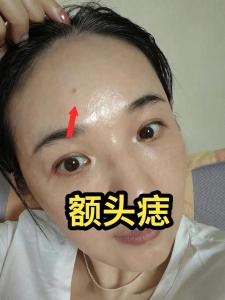 額頭兩側長痣會怎樣