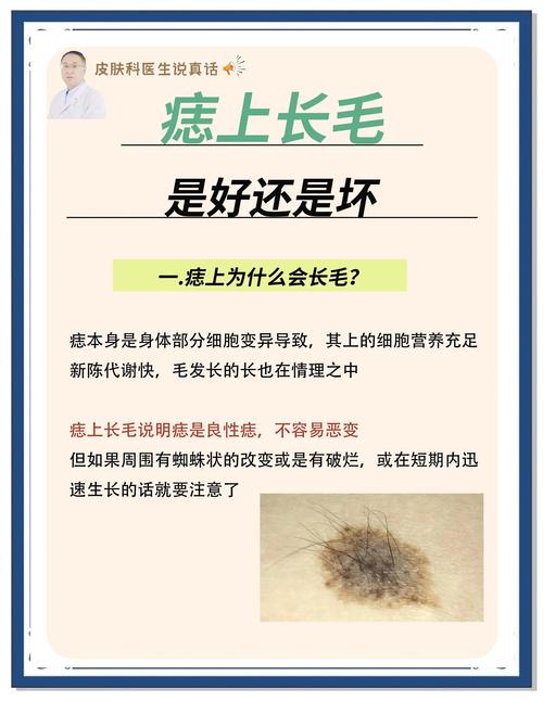 臉上的痣長毛能去掉嗎