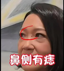 山根有痣一定不好嗎