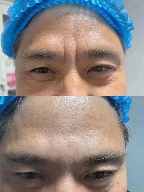 男人有抬頭紋會有好運嗎