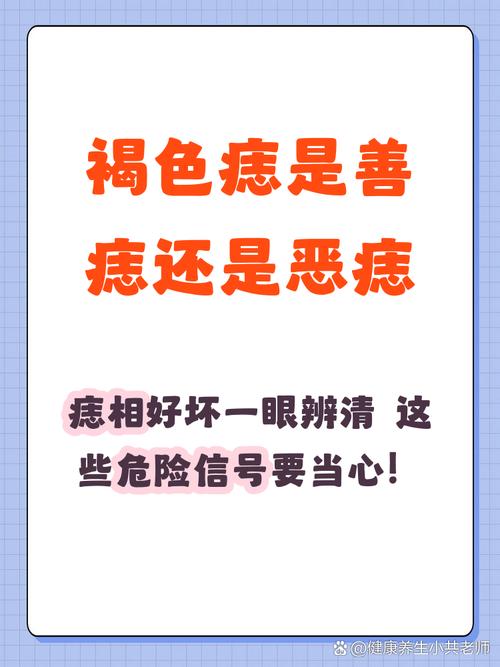 咖啡色的痣是善痣嗎