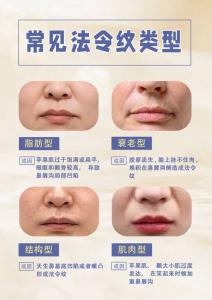 法令紋怎么樣