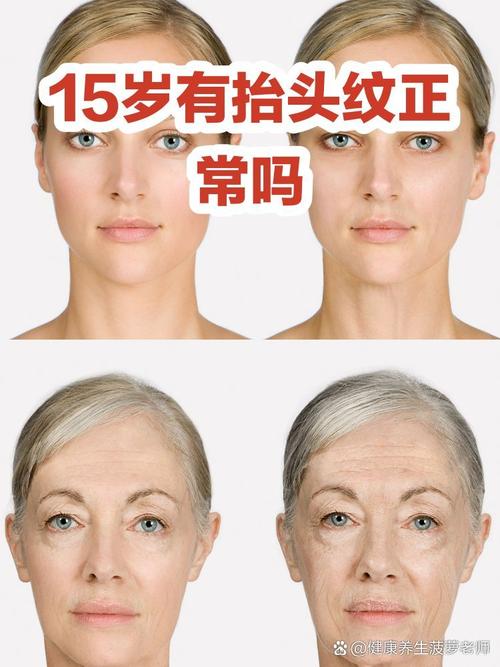 青少年有抬頭紋正常嗎 正常現(xiàn)象