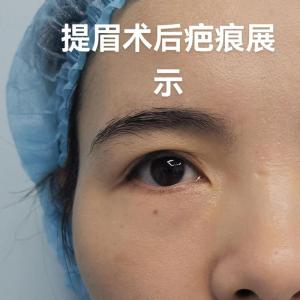 面相眉毛有疤痕會影響運氣嗎？