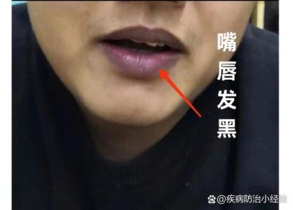 嘴唇發(fā)黑的男人的面相