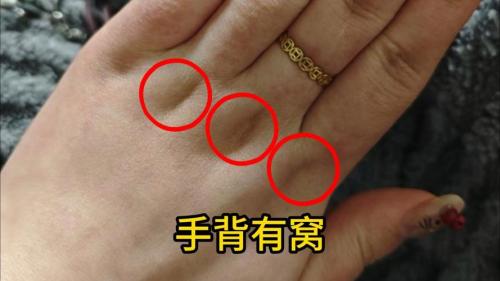 女生手背上留下疤痕寓意 掌心有疤祥瑞之兆