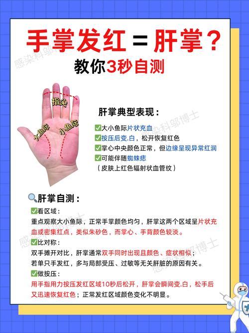 怎么分辨肝掌紅和普通紅 肝掌紅需留意健康運勢