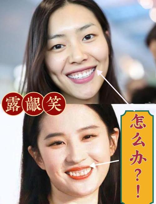 笑起來牙齦外露代表什么