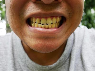 牙齒枯黃的人會是旺夫面相嗎