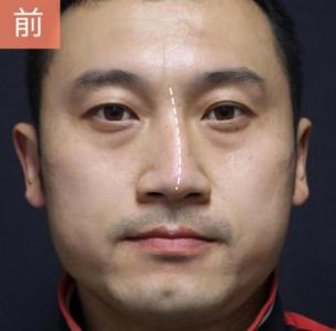 歪鼻子的人命運如何