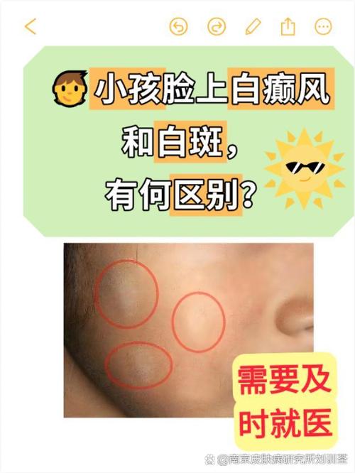詳解：白色胎記好不好？