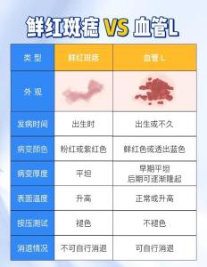 胎記算命圖解：什么是紅胎記？