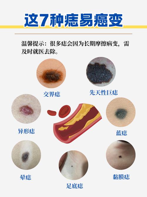 黑痣怎么消除小妙招 是癌變的征兆嗎
