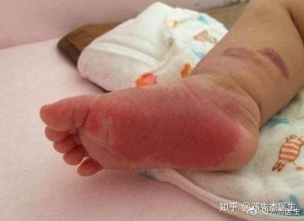 女生腳底有紅色胎記好不好 腳踩紅云是好兆頭嗎