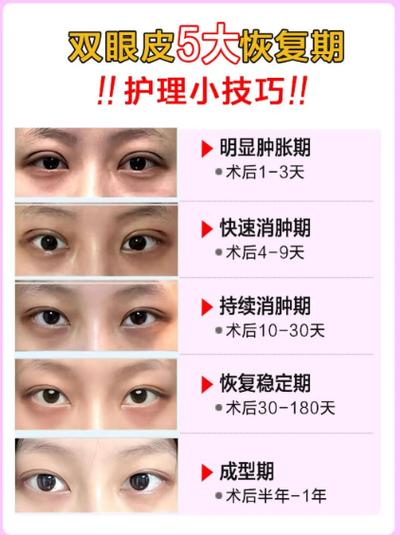 割雙眼皮影響婚姻財(cái)運(yùn)