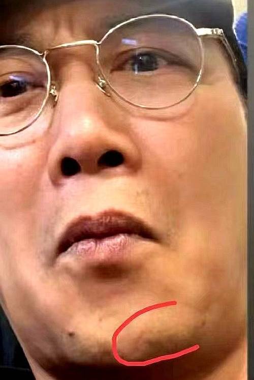 下巴有刀傷會影響晚年運勢嗎
