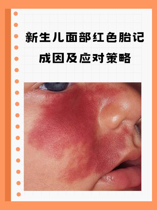 紅色的胎記表示什么，胎記的位置與命運有何聯(lián)系？