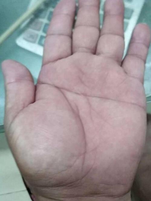 通貫掌是什么引起的，通貫掌病因是什么？