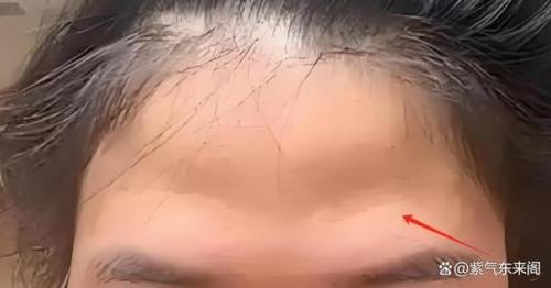眉骨高額頭凹陷很難看