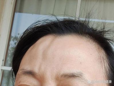 額頭凹凸不平命苦