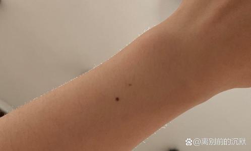左小臂有痣