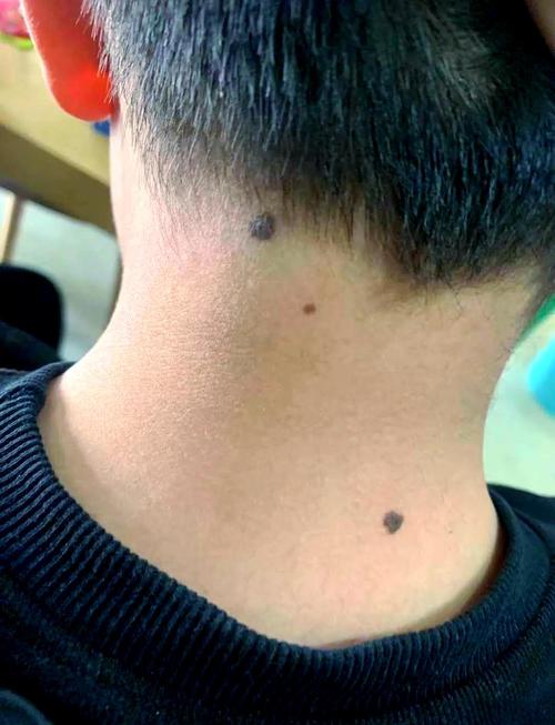 男人脖子長痣好不好，會不會影響財運？