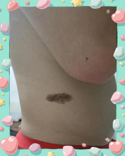 胸部有胎記代表什么，男女有什么不同嗎？
