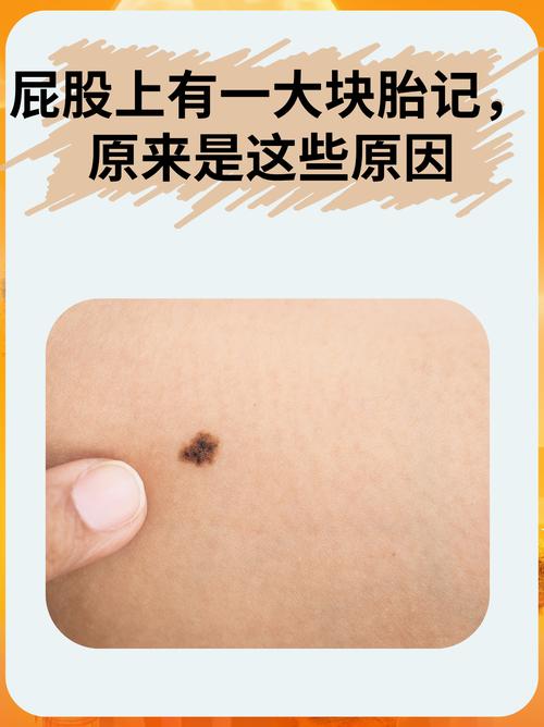 屁股上的胎記好不好，衣食無憂的富貴命？