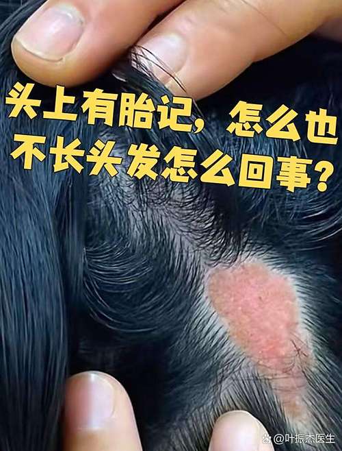 胎記長在后腦勺的人命運如何？財運非常旺盛！