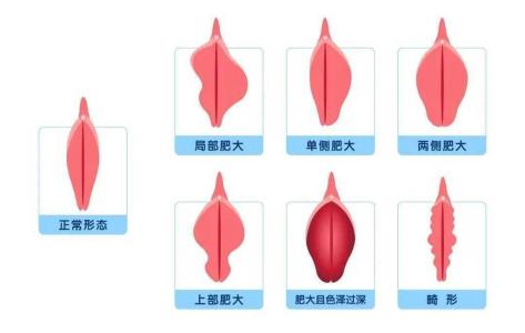 小陰純肥大的女人面相有什么特征