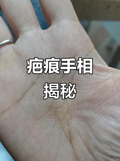 從手相疤痕看你要注意什么