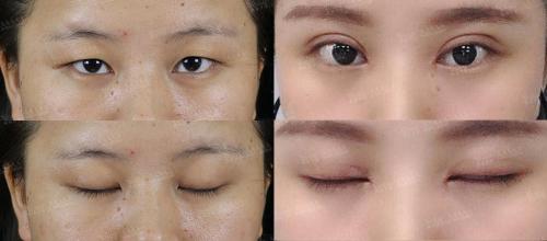 三角眼做雙眼皮效果圖