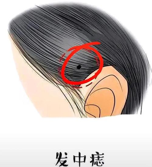 頭發(fā)中有痣的人，真的是天生的富貴命嗎？